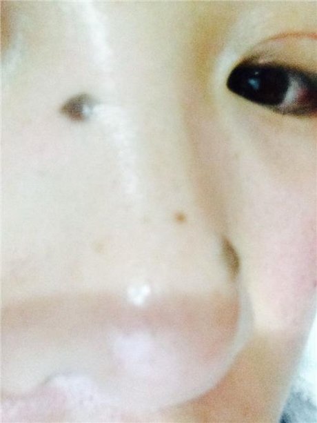 皮内痣