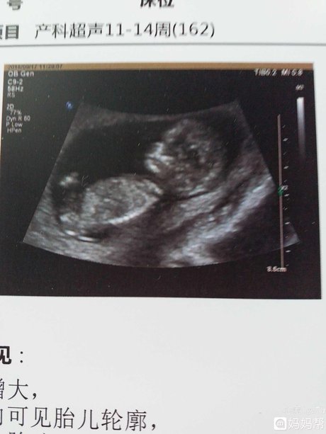 相关搜索 怀孕11周胎儿图 16周胎儿发育情况 18周胎儿发育情况 8周