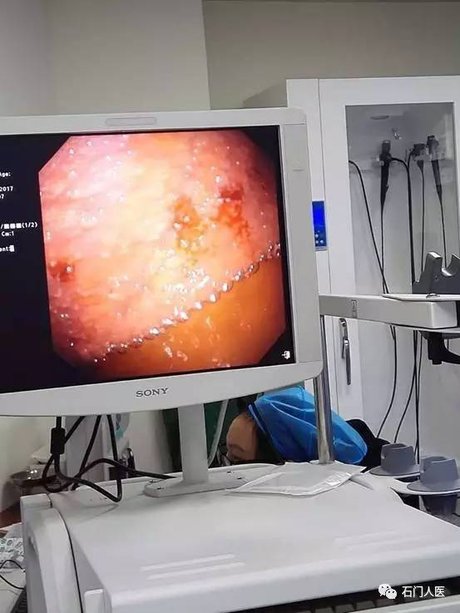 又一惊喜:呼吸科成功开展内科胸腔镜检查及胸膜活检!