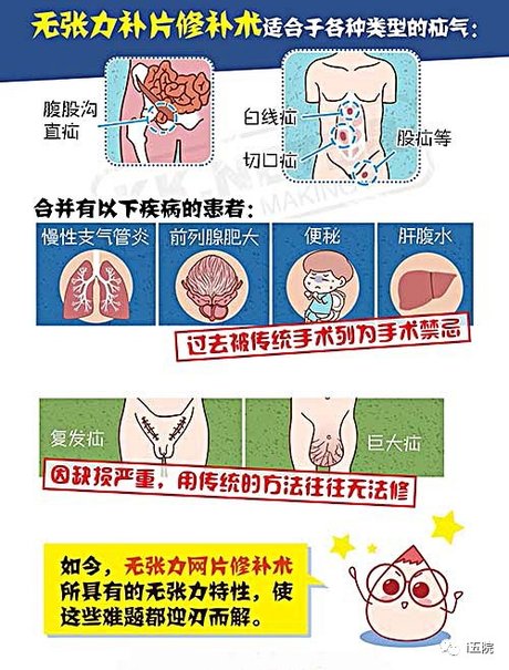 腹股沟直疝_360图片