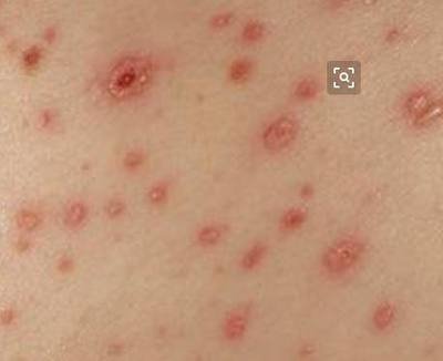 Hiv 初期症状 皮疹