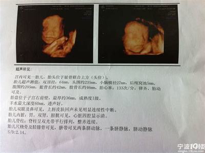 胎儿头偏大是什么原因