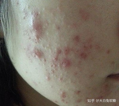 美容院能治好痘痘吗