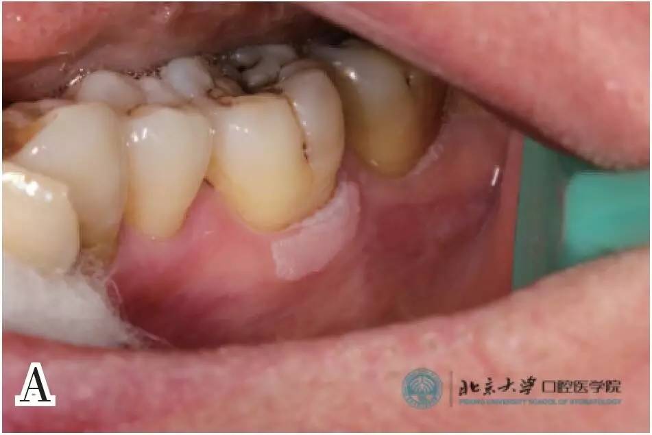 得了口腔白斑怎么治疗