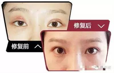 割双眼皮后怎么去淤血