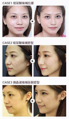 童颜针和水光针的区别