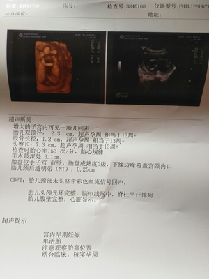 胎盘在右侧壁胎儿图片