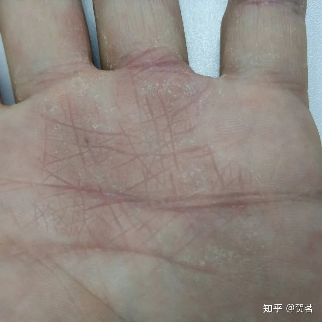 汗疱疹怎么治疗