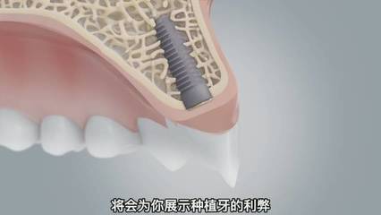 种牙到底疼不疼
