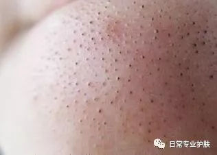 男生鼻子上痘痘是什么原因