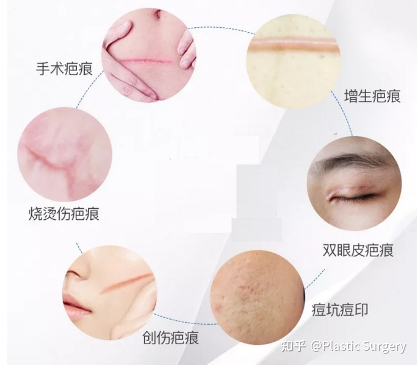 皮秒祛斑多久做一次