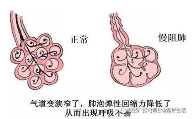 气道狭窄怎么治疗