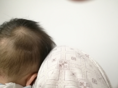 新生儿头后面凹陷图片