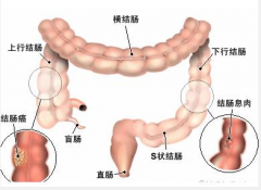 结肠息肉怎么治疗