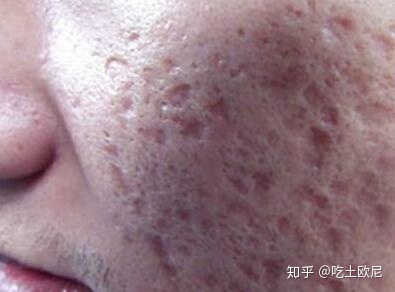 鼻子两边毛孔粗大是什么原因