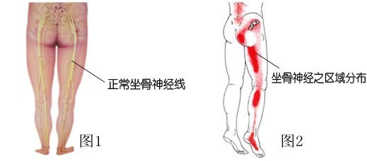坐骨疼是怎么回事
