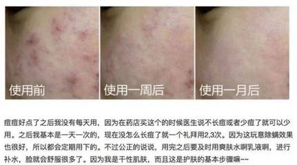 背部痘痘硫磺皂的作用