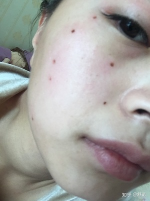 点痣后多久不能晒太阳