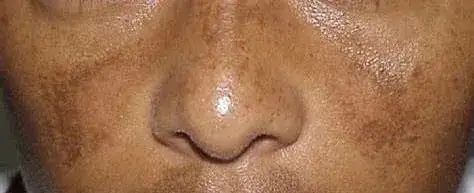 鼻梁长痘痘的原因