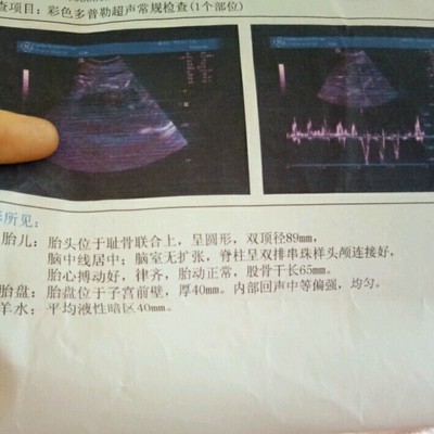 胎儿头偏大是什么原因