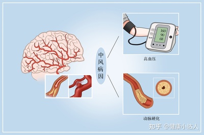 脑卒中怎么治疗