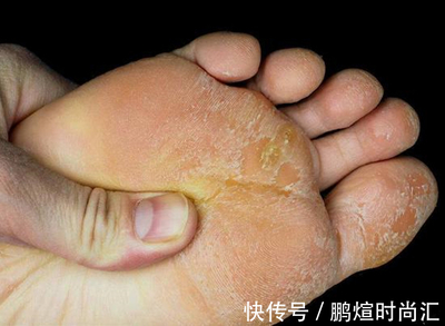 脚板烂了是怎么回事