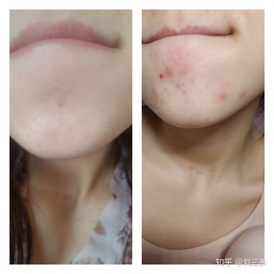 资深痘痘