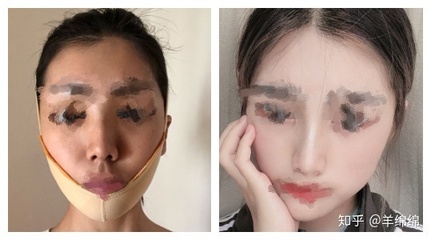 黄金微雕瘦脸