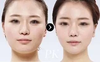 瘦脸针能瘦脸么
