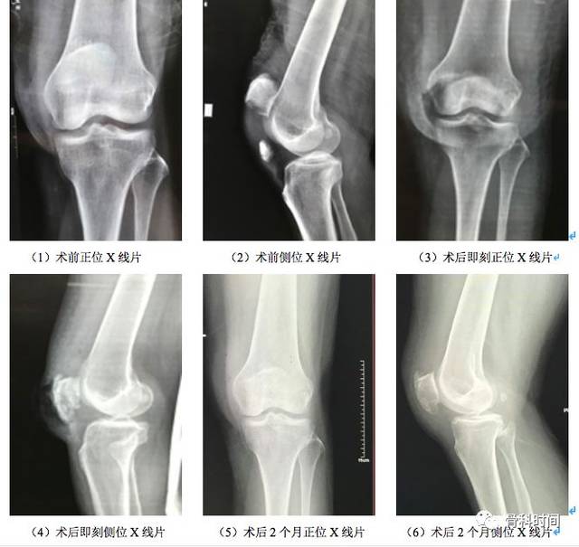 膝盖髌骨骨折怎么治疗