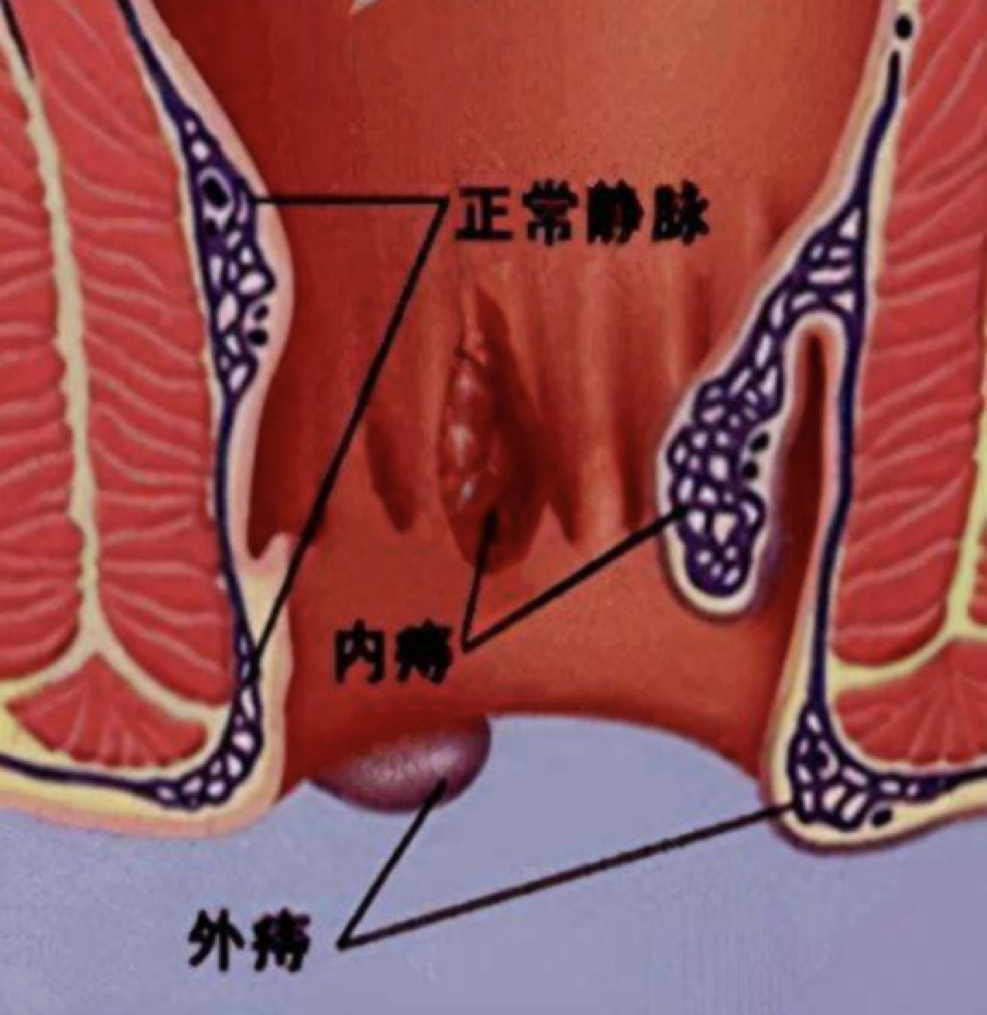 内痔外痔怎么治疗