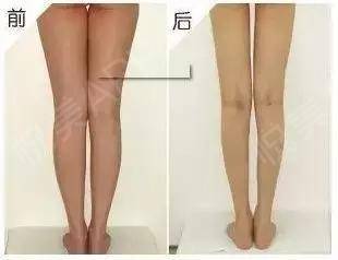 瘦腿吸脂