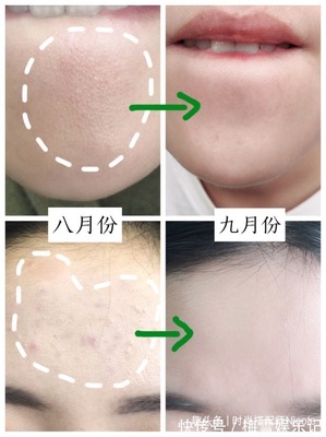 闭口痘痘粗糙