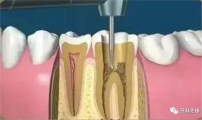 根管治疗怎么治