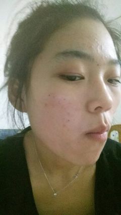 额头有痘痘是因为什么原因