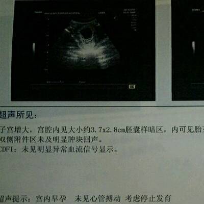 药流后容易再怀孕吗