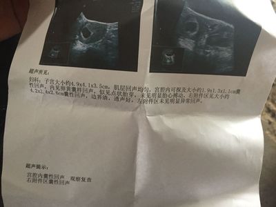 怀孕几天有孕囊