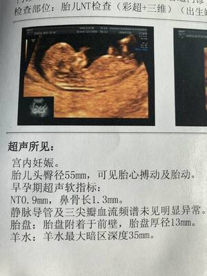 胎儿头偏大是什么原因