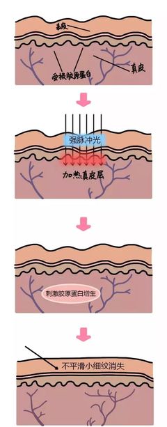 强脉冲光能祛痘痘吗