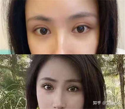 双眼皮如何修复