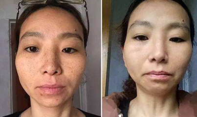 脸上突然长斑是怎么回事