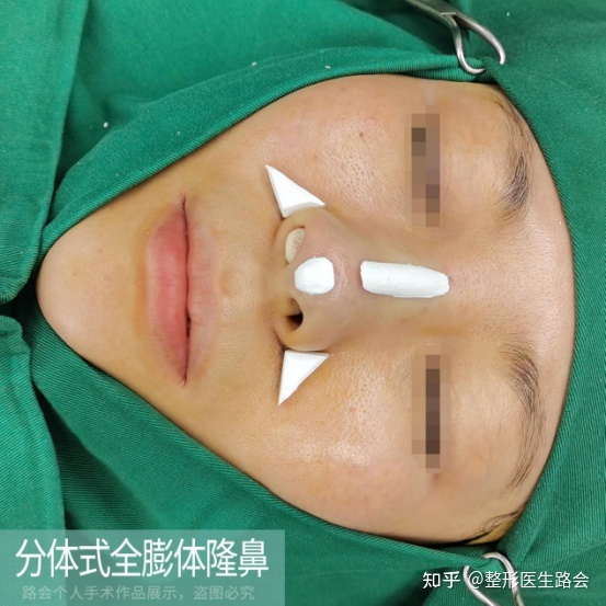 分体式隆鼻