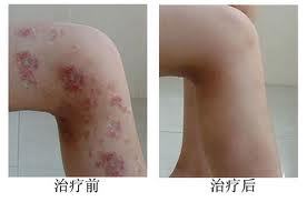 成都皮炎所治痘痘