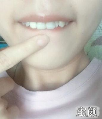 换一颗烤瓷牙多少钱