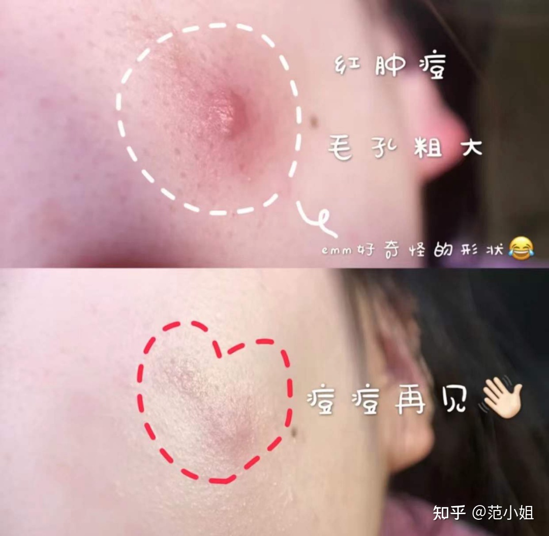 脸上红肿痘痘痘印