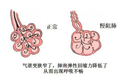 气道狭窄怎么治疗