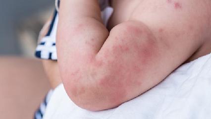 热气导致的痘痘怎么消