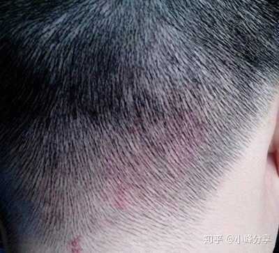 小孩起头皮屑是怎么回事