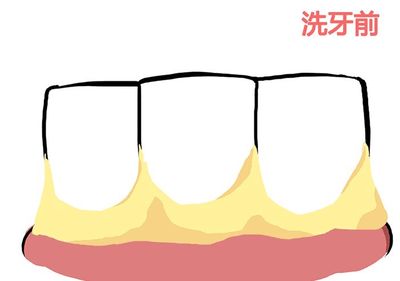 洗牙前要刷牙吗