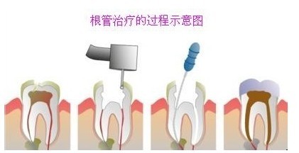 牙疼根管治疗是怎么治疗的